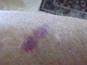 Oct 30th, after two days the blistering is almost all gone.