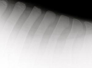 No evidence of kissing spine