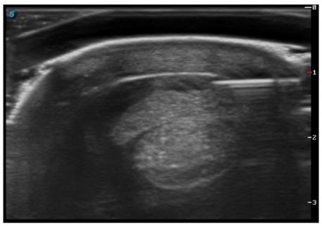 An ultrasound guided technique is often used to inject stem cells  into an injured area. 