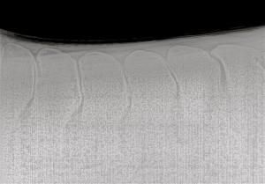 A radiograph example of kissing spine