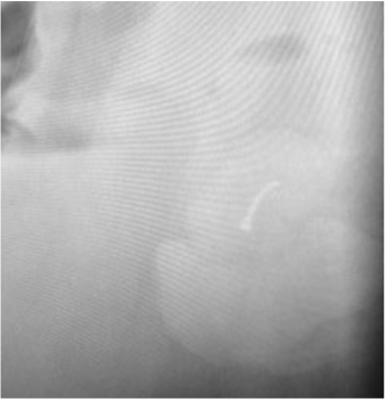 Digital x-ray of enterolith with foreign body (horse shoe nail) inside